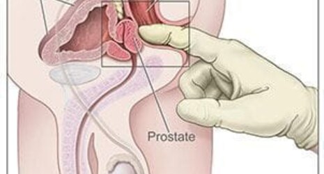 Comment trouver la prostate ?
